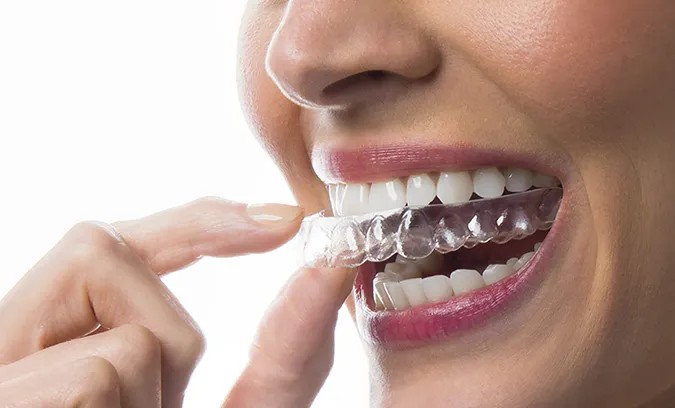 Aligners Treatment
