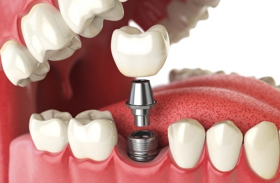 Dental Implants