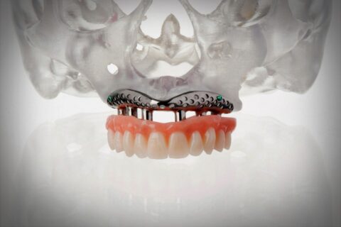 Patient Specific Implant