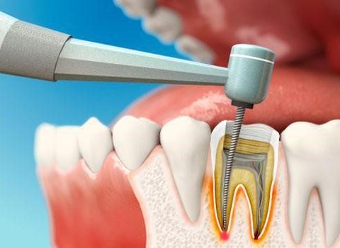 Root Canal Treatment